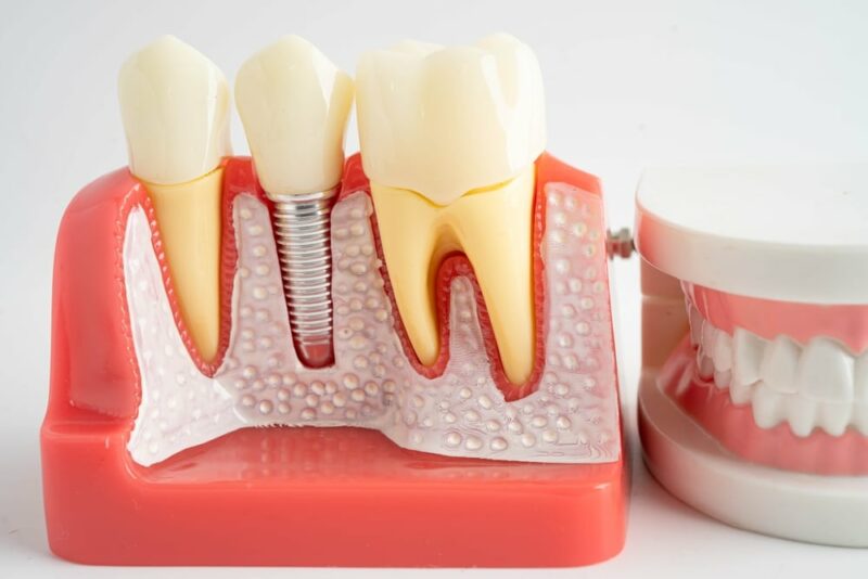 Dental Implants Horizon City